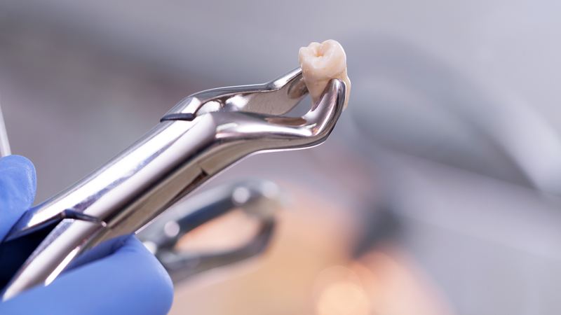 Tooth Extraction: What to Expect Before, During, and After